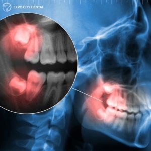 Signs of Impacted Wisdom Teeth
