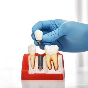 The Step-by-Step Process of Getting Dental Implants