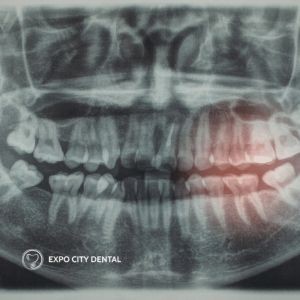 xray of impacted wisdom teeth in lower jaw