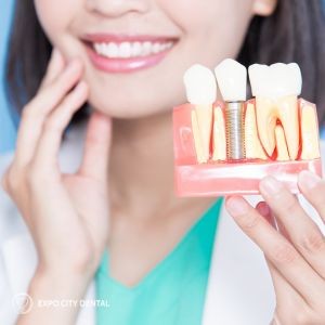 How Dental Implants Compare to Bridges and Dentures