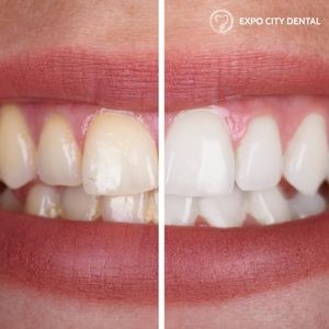 How At-Home Kits Compare to Professional Teeth Whitening