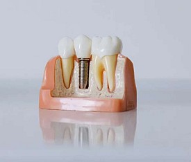 Dental Implants