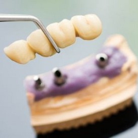 Dental Bridges