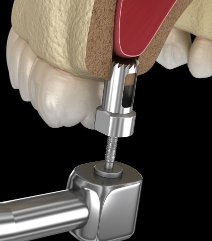 Sinus Lift