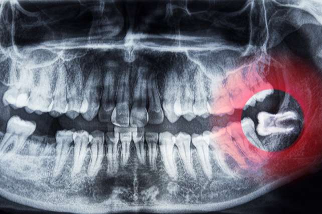 Wisdom Teeth & Complicated Extraction