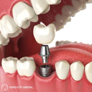 dental implants vaughan