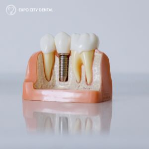 dental implants vaughan