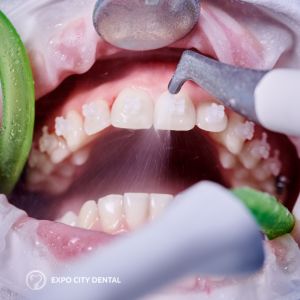 patient undergoing teeth cleaning during dental appointment in Vaughan