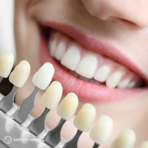 teeth whitening vaughan