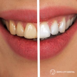 teeth whitening vaughan