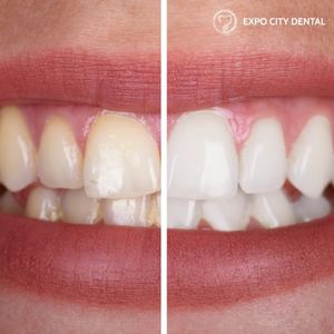 teeth whitening vaughan