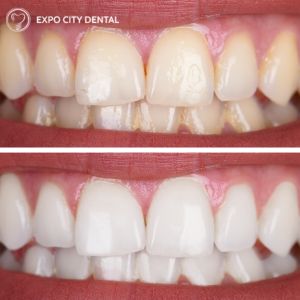teeth whitening vaughan